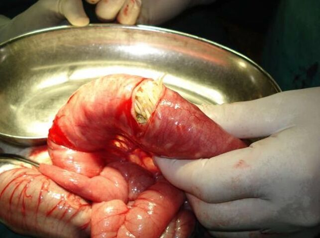 viermi în intestinul uman