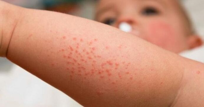 erupție cutanată ca simptom al infecției cu paraziți